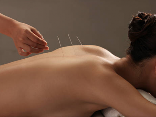 Acupuncture