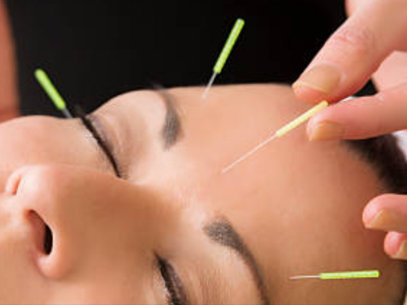 Acupuncture